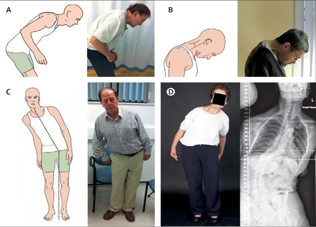 Body deformity disorder2