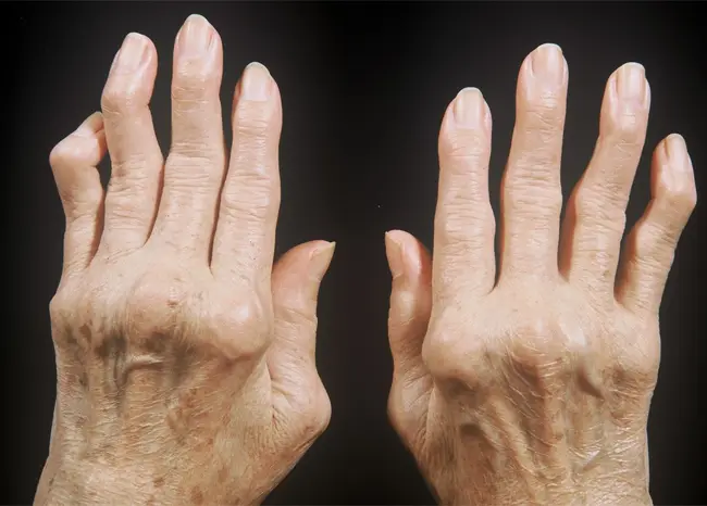 Body deformity disorder3