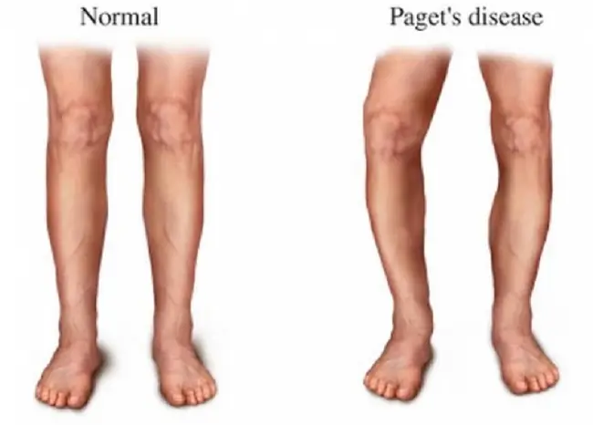 Body deformity disorder4